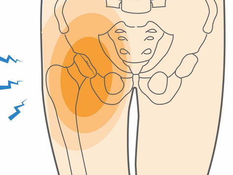 Hip Labral Tears: How Physiotherapy Supports Recovery