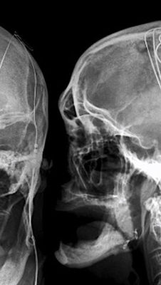 Desbloqueando a esperança por meio da estimulação cerebral profunda para depressão resistente ao tratamento