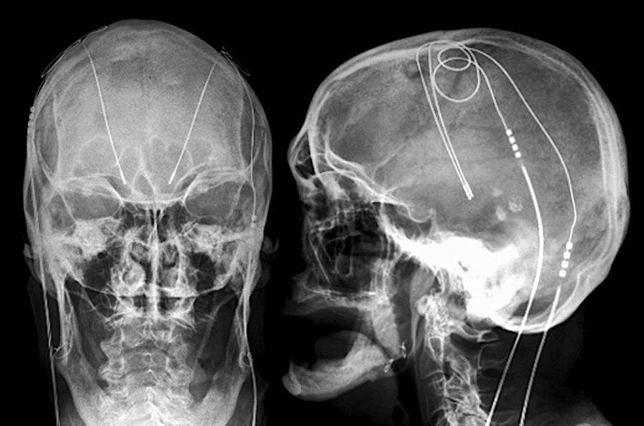 Desbloqueando a esperança por meio da estimulação cerebral profunda para depressão resistente ao tratamento