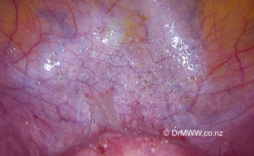 Endometriosis and the Urinary Tract