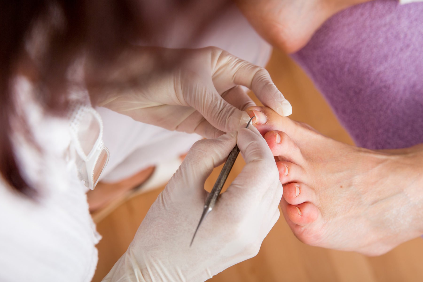 ingrown tow nail care.png