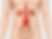 Aneurisma de aorta abdominal (AAA)