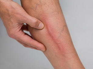 Tromboflebitis superficial: síntomas, riesgos y tratamiento