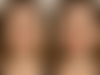 "Comparativo de antes e depois de procedimento estético facial em mulher, mostrando melhora na harmonização, textura da pele, volume labial e linhas de expressão."