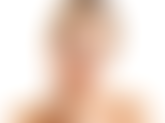 What Are the Benefits of Ultherapy Treatment?