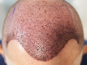 What’s the Hair Transplant Cost? Find Out!