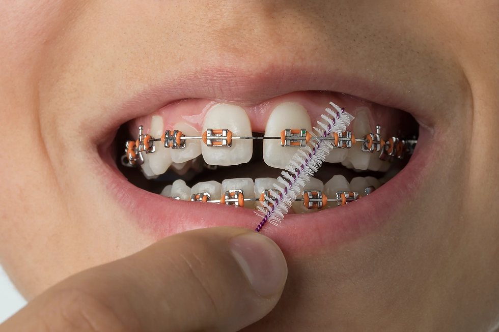 Why Choose Metal Braces in Dubai for Your Smile?