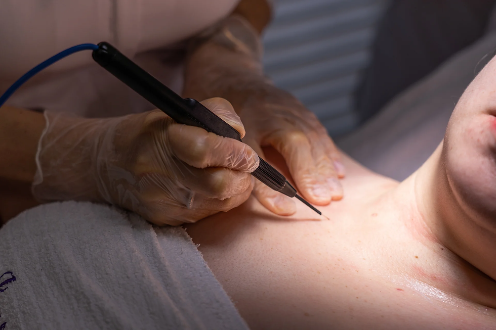 Quick Guide: How to Remove Skin Tags on Inner Thigh