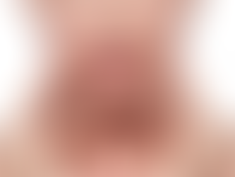 How Does Chin Reduction Affect Your Facial Profile?