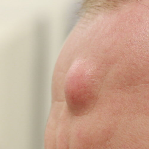 Lipoma Treatment Solutions: What You Need to Know