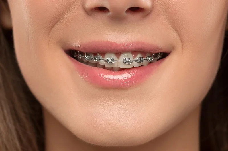 Transform Your Smile with Metal Braces in Dubai