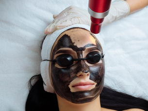 Carbon Peel – Hollywood tretman za čistu i blistavu kožu
