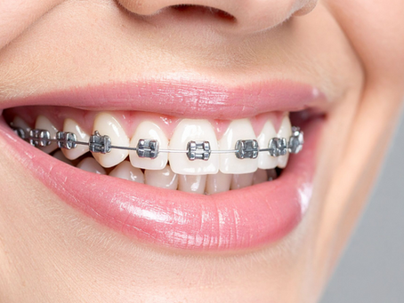 Qué alimentos evitar con brackets: guía práctica para cuidar tu ortodoncia fija