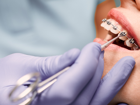 Cómo cepillarte los dientes con brackets: técnica de cepillado para ortodoncia fija