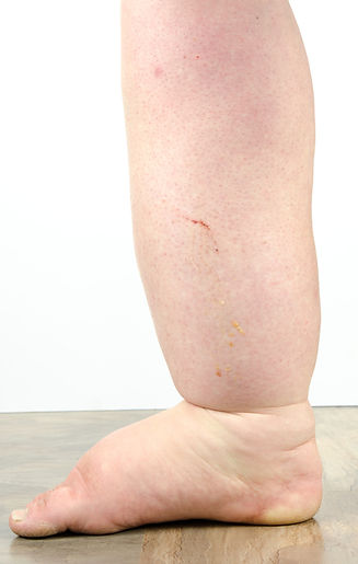 edema-of-the-leg-and-foot.jpeg