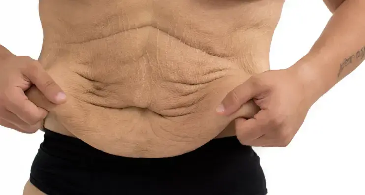Does loose skin after weight loss go away
