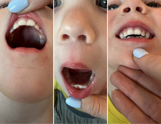 Thumb-Sucking Impact on Dental Health | The Peaceful Sleeper