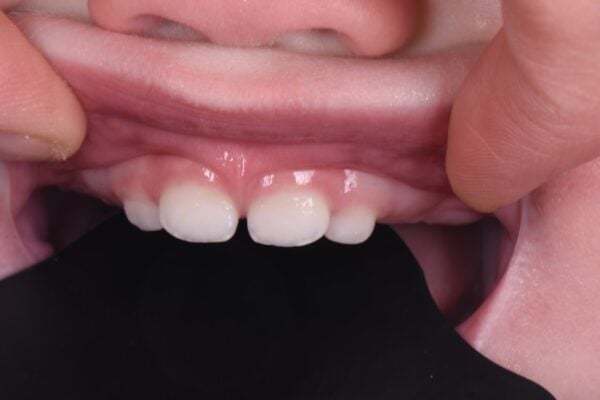 Lip Tie | The Peaceful Sleeper