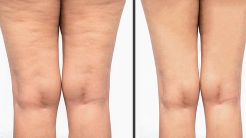 la stessa donna in due  momenti diversi, prima e dopo aver effettuato i trattamenti non invasivi e non dolorosi del centro dimagrimento Overclass Padova