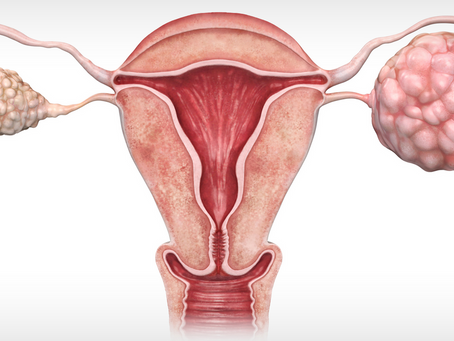 Ovarian Cancer