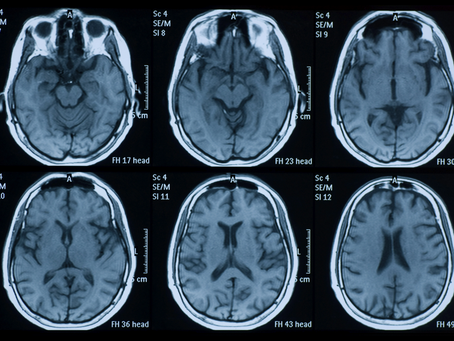 Parkinson's Disease