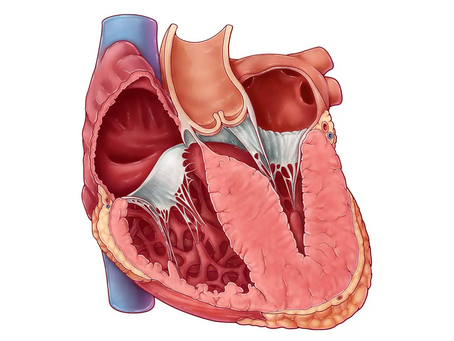 Hypertrophic Cardiomyopathy