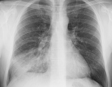 Pneumonia