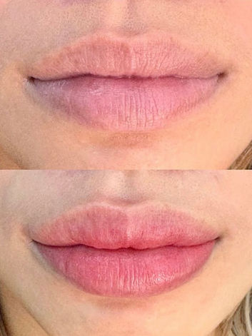 Lip blush cosmetic tattoo in North Sydney showcasing enhanced lip colour, improved definition, and a soft, natural tint for a fresh and youthful appearance.