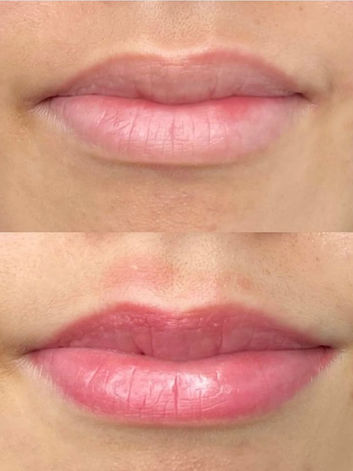 Lip blush cosmetic tattoo in North Sydney showcasing enhanced lip colour, improved definition, and a soft, natural tint for a fresh and youthful appearance.