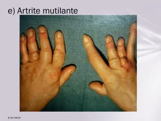 Deformidade de mãos causada por artrite psoriásica