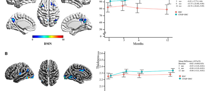 No.305 睡眠時無呼吸症候群のCPAP治療は脳の構造と機能を改善させる