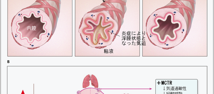 No.207 喘息薬、ロイコトリエン受容体拮抗薬に関する新しい考え方?
