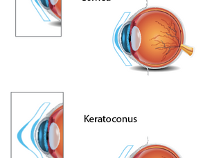 Keratoconus: Symptoms, Causes, Treatment & Early Detection