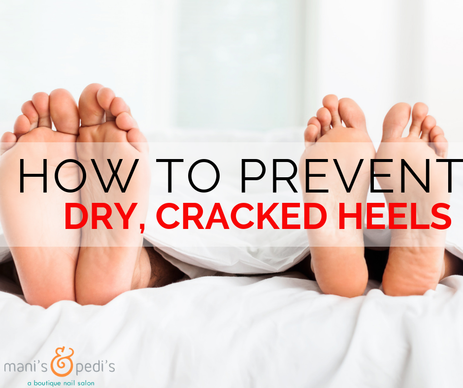 How To Prevent Dry Cracked Feet