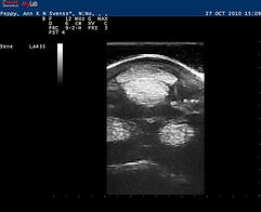 43 days after the first ultrasound scann