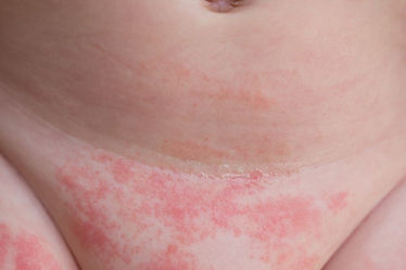 windeldermatitis.jpg