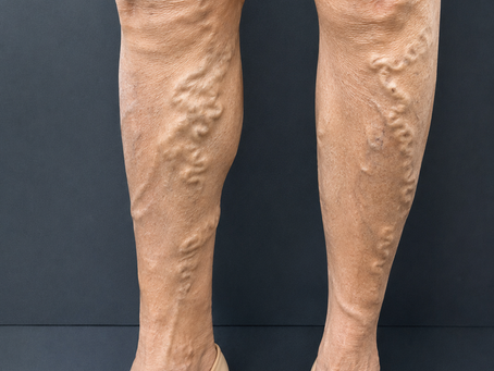 Espuma ou cirurgia para varizes: qual o melhor tratamento?