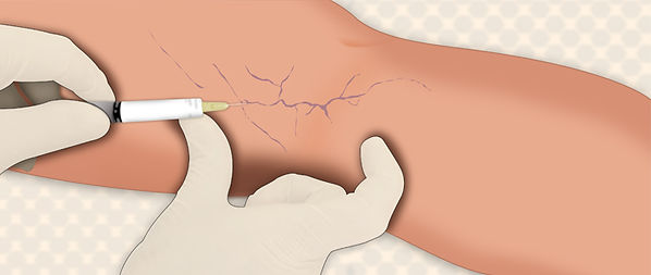 escleroterapia com espuma.jpg