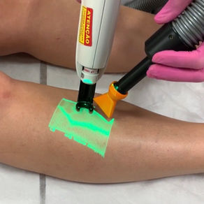 Laser transdérmico Nd:YAG 1064 sendo aplicado em uma microvariz, com auxílio da realidade aumentada (luz verde) e do resfriador de pele (dispositivo laranja). Por Dra. Juliana Puggina, cirurgiã vascular em São Paulo.