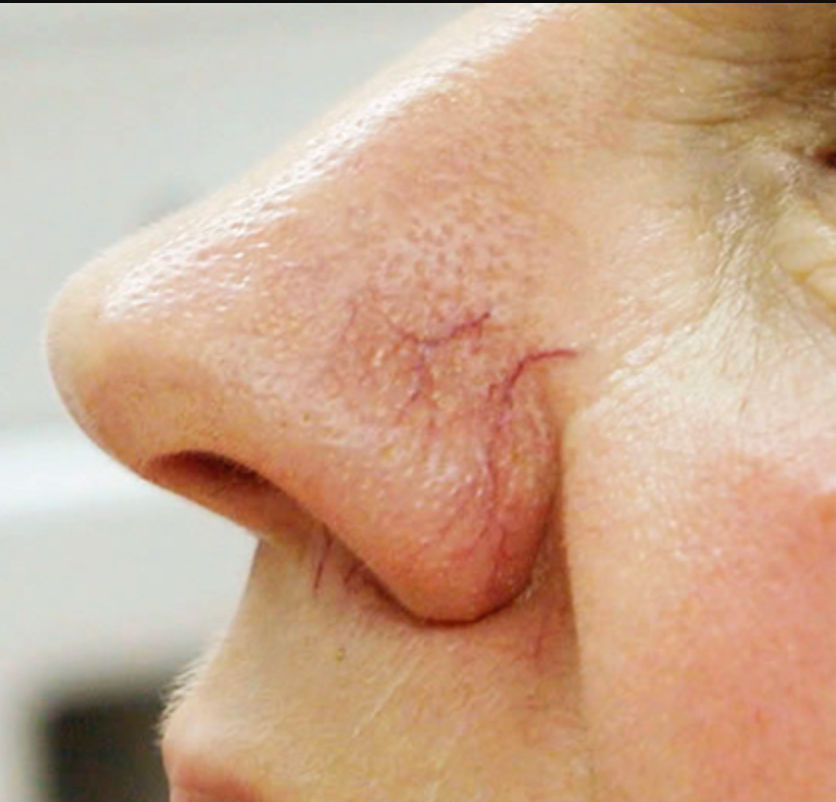 Close de perfil do nariz mostrando vasinhos (telangiectasias faciais) avermelhados e ramificados na asa e na lateral nasal, condição estética comum tratada com laser Nd:YAG