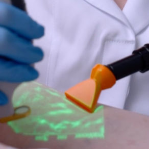 Dra. Juliana Puggina realizando tratamento CLaCS com laser em vasinhos nas pernas, com iluminador de veias por realidade aumentada vein viewer projetando o mapa dos vasos sobre a pele e ponteira laranja de resfriador de pele.