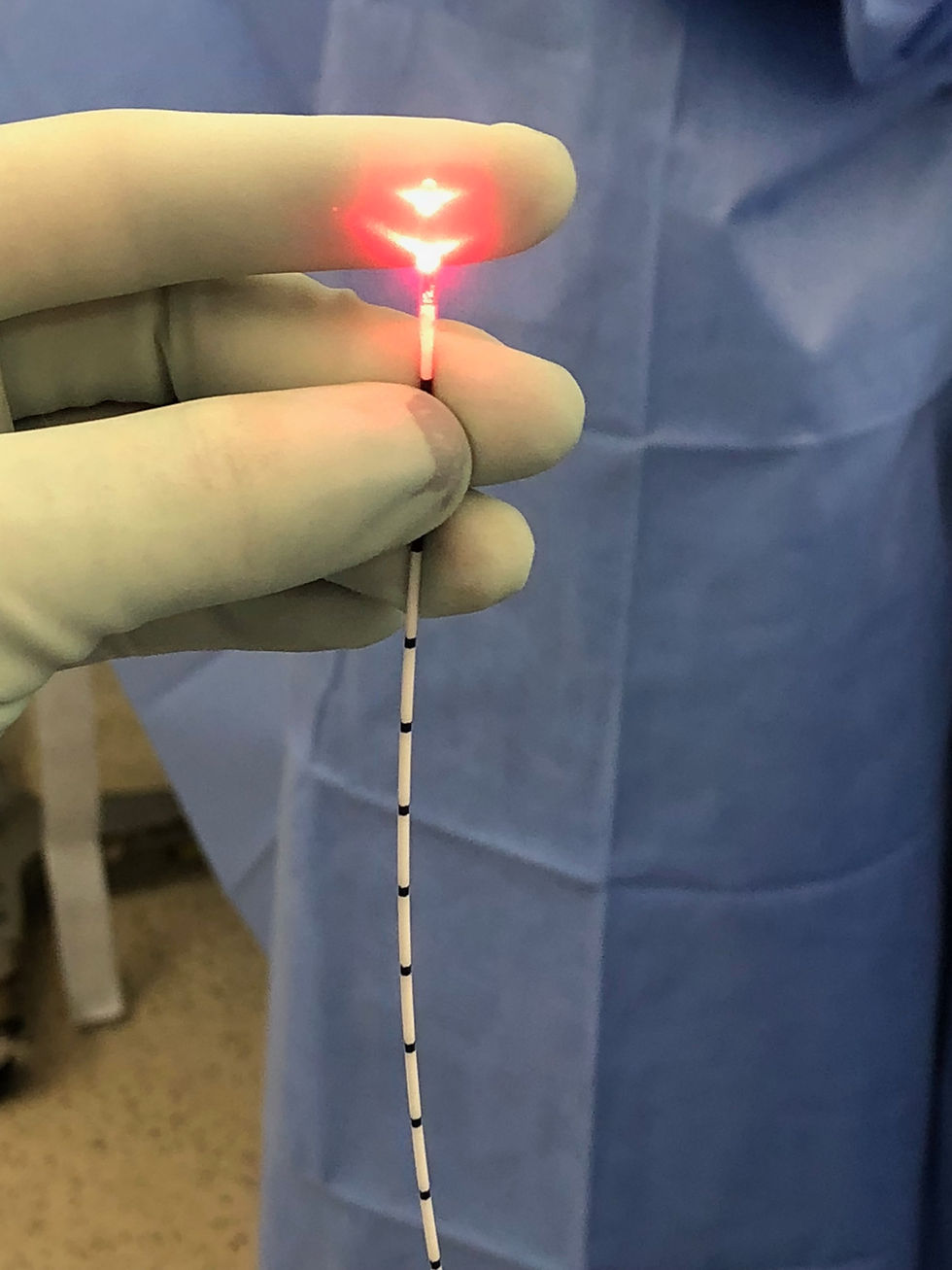 Fibra óptica do laser para tratamento da veia safena, com luz-guia ligada antes do procedimento. Tratamento minimamente invasivo realizado pela Dra. Juliana Puggina, cirurgiã vascular em São Paulo.