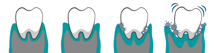 Icons_Grafiken_ZAS_Parodontose-03.png