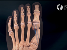 Små snitt kan gi store forbedringer