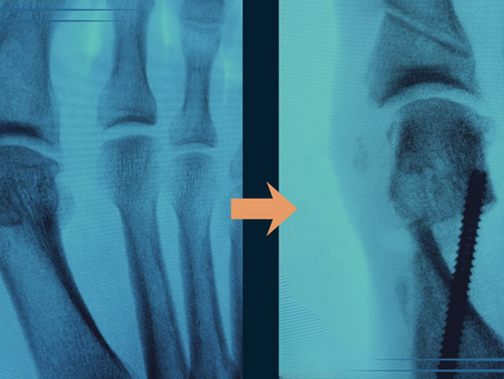 Røntgenbilde ved Hallux Valgus – vurdering og operasjonsplanlegging