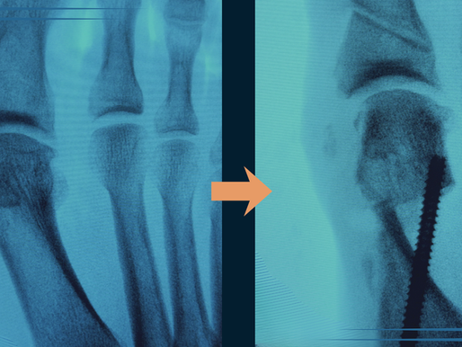 Skruer etter Hallux Valgus-operasjon: hvorfor brukes de, og må de fjernes?