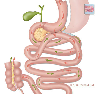 Mini gastric bypass