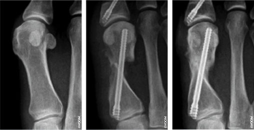 Hallux Valgus røntgen etter operasjon kikkhullsteknikk