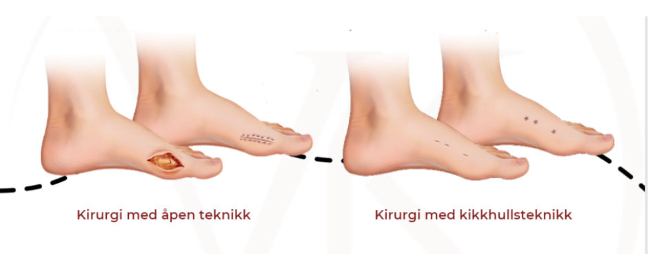 Forskjellen mellom åpen kirurgi for Hallux Valgus og kikkhullskirurgi