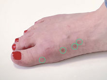 Jobbe etter Hallux Valgus-operasjon – rehabilitering i Bergen